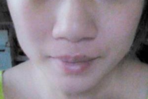 寧波二院美容科怎么樣割雙眼皮那個(gè)醫(yī)生好|案例