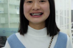 蘇州美澳口腔醫(yī)院怎么樣牙齒矯正果