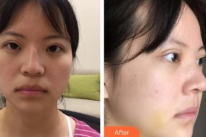 韓洪軍整形價格表附鼻部綜合案例展示