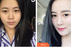 張志義整形價格表附鼻部綜合案例展示