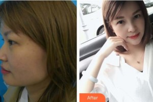 晉江東方醫(yī)療美容醫(yī)院劉金鳳整形價格表附鼻部綜合案例展示