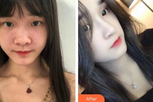 右江民族醫(yī)學(xué)院附屬醫(yī)院燒傷整形外科黃志群整形價格表附假體隆鼻案例展示