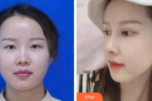 盛京醫(yī)院滑翔分院醫(yī)療整形美容科王宇令整形價格表附肋軟骨隆鼻案例展示