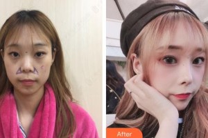 賈治蘭整形價格表附鼻部綜合案例展示