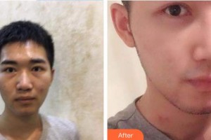 張勁整形價格表附鼻部綜合案例展示