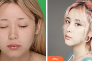 韓瑩整形價格表附假體隆鼻案例展示