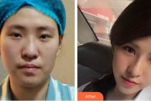 酒泉醫(yī)學(xué)整形美容門診部高俊整形價格表附膨體隆鼻案例展示