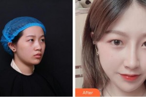 揭陽華美整形美容醫(yī)院歐東輝整形價格表附肋軟骨隆鼻案例展示