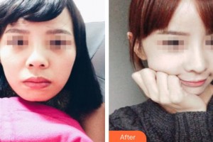 新泰僑藝外科美容診所杜繼珍整形價格表附鼻部綜合案例展示