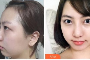 鐘曉整形價格表附鼻骨矯正案例展示