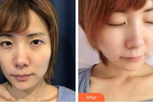 金鄉(xiāng)縣人民醫(yī)院醫(yī)學(xué)美容科張婭整形價(jià)格表附E光嫩膚案例展示