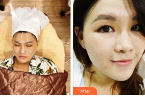 許成芳整形價(jià)格表附光子嫩膚案例展示