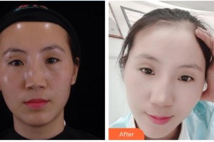 李建輝整形價(jià)格表附激光祛斑案例展示