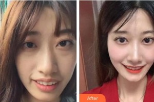 曹燕妮整形價(jià)格表附牙齒陶瓷矯正案例展示