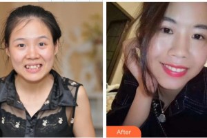 李建整形價(jià)格表附自鎖托槽矯正案例展示