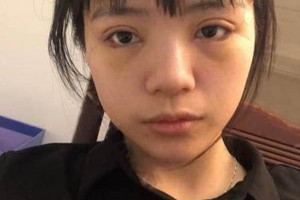 廈門海峽整形醫(yī)院雙眼皮果？附果圖及案例展示