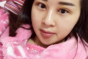 沈陽陸軍總醫(yī)院美容外科雙眼皮附果圖價(jià)格一覽