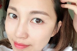 廣州新生植發(fā)醫(yī)院靠譜嗎發(fā)際線回歸歷程|價(jià)格表