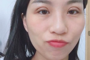 浙江嘉興榮軍醫(yī)院環(huán)境怎么樣割雙眼皮日記|價(jià)格表