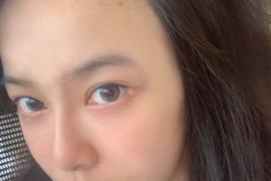 洛陽(yáng)150醫(yī)院整形科植發(fā)項(xiàng)目怎么樣附圖片對(duì)比