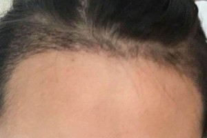 北京同仁醫(yī)院整形美容外科怎么樣？（附果圖）