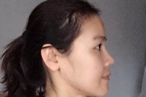 揚州市人醫(yī)美容科怎么樣附果圖