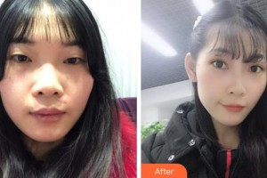 整形價(jià)格表附雙眼皮案例展示