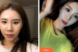 熊永田整形價(jià)格表附雙眼皮案例展示