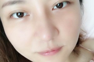 武漢亞太整形隆鼻怎么樣？真人案例+醫(yī)生介紹
