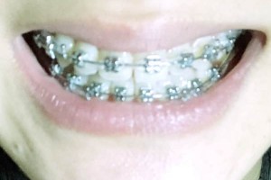 株洲家鴻口腔醫(yī)院牙齒矯正/術(shù)后果&價格表