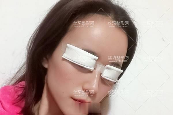 寧波113整形美容醫(yī)院？雙眼皮3個(gè)月果|整形專(zhuān)家詳情