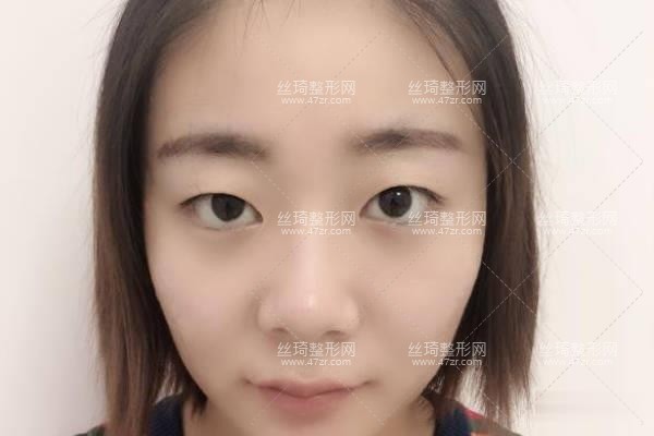 河南省人民醫(yī)院整形科王凱雙眼皮？知名醫(yī)生推薦&費(fèi)用表