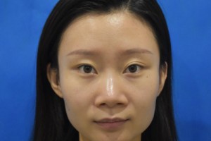 空軍總醫(yī)院隆鼻的費用？2021費用表+醫(yī)生推薦