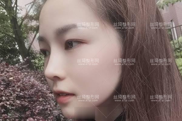 西安市第四醫(yī)院美容科價(jià)格表公布隆鼻3個(gè)月果|整形專(zhuān)家詳情