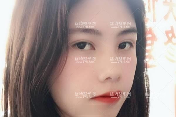 上海九院怎么樣？雙眼皮3個月果|整形專家詳情