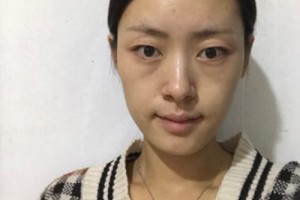 華康整形醫(yī)院正規(guī)嗎？隆鼻成功案例&費(fèi)用表