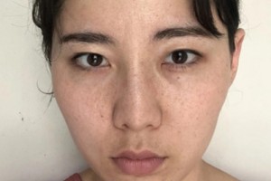 浙一激光美容科？真人實(shí)拍對(duì)比&費(fèi)用表