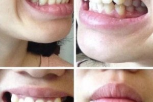 西安中諾口腔醫(yī)院評(píng)價(jià)？牙齒矯正成功案例分享！