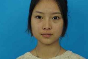 濟(jì)南華僑醫(yī)院雙眼皮咋樣？醫(yī)生技術(shù)如何/費(fèi)用表