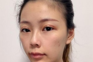 南方醫(yī)院苗勇植發(fā)果好不好？真實(shí)案例分享