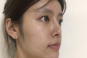 京民整形醫(yī)院假體隆鼻靠譜嗎？親身經(jīng)歷分享&對比圖