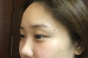 武漢協(xié)和醫(yī)院美容科怎么樣 ？去眼袋果圖