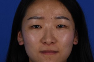 上海伊萊美容醫(yī)院口碑怎么樣？雙眼皮案例對比圖