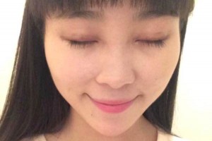 臨沂市人民醫(yī)院雙眼皮怎么樣？注意事項(xiàng)+術(shù)前準(zhǔn)備必看