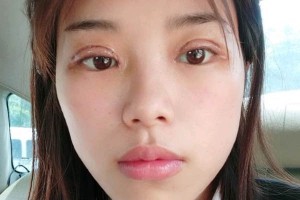 長沙亞韓整形醫(yī)院雙眼皮價格？術(shù)后幾點(diǎn)需注意！