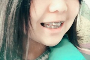 四川華西口腔醫(yī)院？牙齒矯正術(shù)后分享！