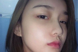 廣州軍區(qū)總醫(yī)院整形科好不好|下頜角手術日記&價格表