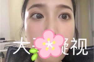 成都西嬋整形醫(yī)院雙眼皮術(shù)后恢復(fù)記錄！快看