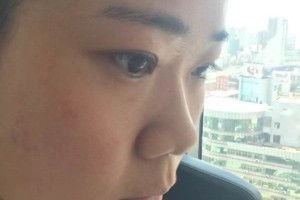 成都恩喜整形醫(yī)院膨體隆鼻正規(guī)嗎？醫(yī)生推薦