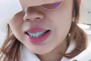 上海摩爾口腔/牙齒矯正真實(shí)案例&果圖